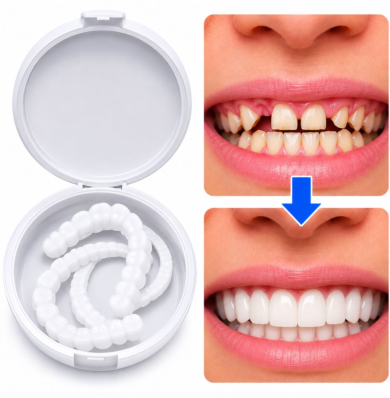 Facettes adaptables et amovibles : Haut + Bas 🦷